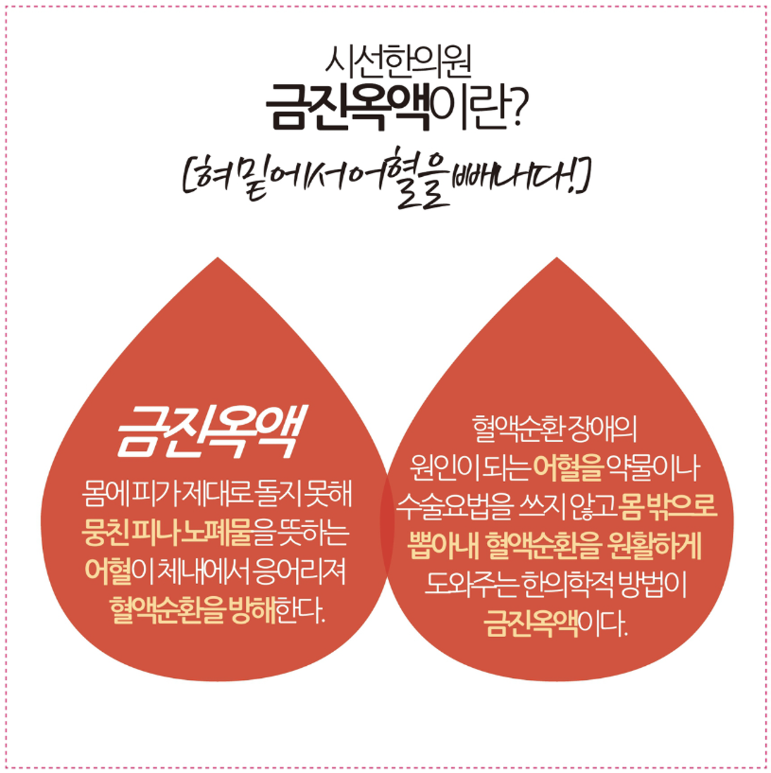 None, 금진옥액 사혈요법은 혀의 아래 금진과 옥액이라는 정맥혈을 사혈합니다. 혈액순환 장애의 원인이 되는 어혈을 약물이나 수술요법을 ... | SEASUN Korean Medicine Clinic