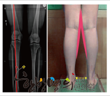 Knock-knees, Legs in the form of X, have a bean form of curvature. In other words, ... | SEASUN Korean Medicine Clinic