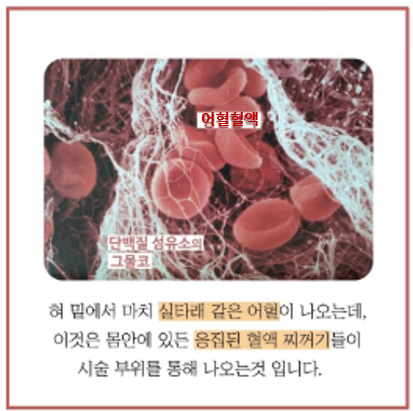 혀 아래의 혈점에서 어혈을 제거하는 치료!, 혀 아래의 혈점에서 어혈을 제거하는 치료법으로 기존의 사혈요법이 소량의 혈액을 제거하는데 그친 반면 상당히 많은 ... | SEASUN Korean Medicine Clinic